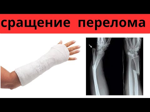 Видео: Как ускорить срастание костей при ПЕРЕЛОМЕ