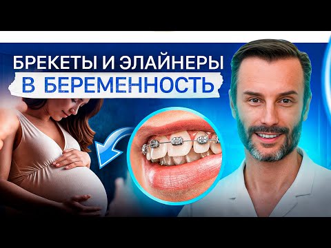 Видео: Можно ли ставить и носить брекеты/элайнеры во время беременности?