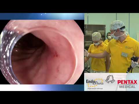 Видео: Диагностика и эндоскопическая диссекция по подслизистому слою раннего рака желудка. О. Б. Ткаченко