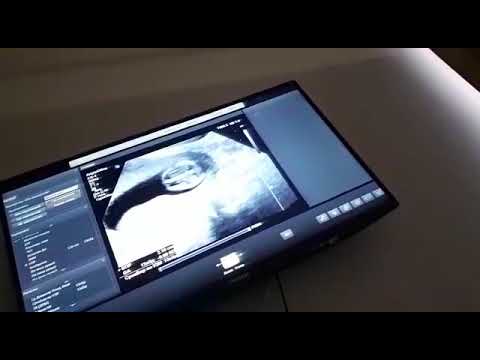 Видео: Узи 12 апта 5 кун Уул