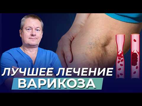 Видео: Секрет здоровых вен в ваших икрах: как победить ВАРИКОЗ и избежать ТРОМБОФЛЕБИТА!