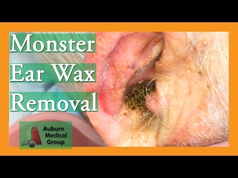 Видео: Ухо Воск для удаления для потери слуха