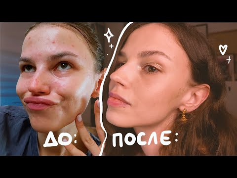 Видео: чистая кожа навсегда. мой опыт лечения системными ретиноидами