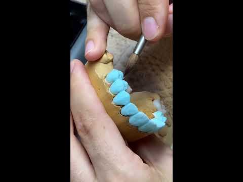 Видео: Feldspathic Crowns on refractory керамика зубной техник Техника нанесения dental technician technik