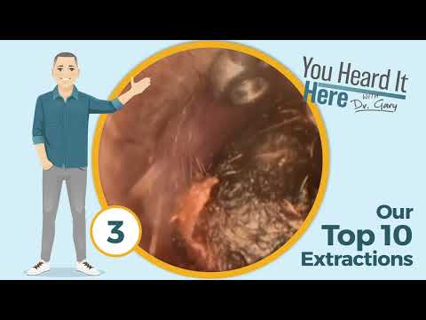 Видео: Ушная сера — 10 лучших способов чистки