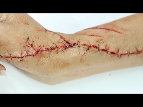 Видео: Свежие швы протезирования