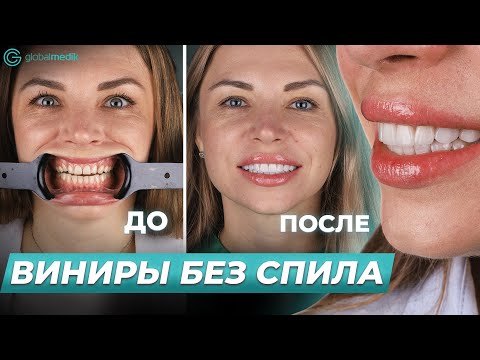 Видео: Сделала E-max Виниры в Турции: Личный опыт медицинского эксперта