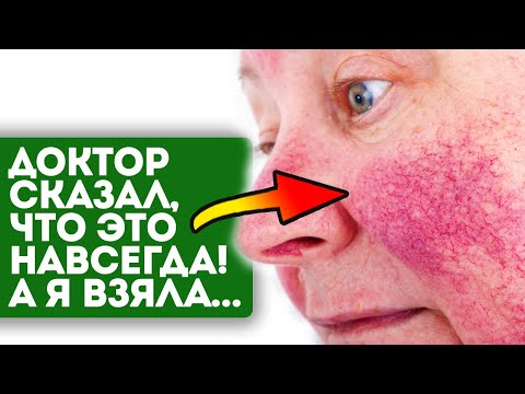 Видео: Купероз как ветром сдуло! 4 ст.л. уксуса + 2 ст.л. мёда + 2 ст.л...
