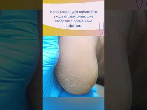 Видео: Медицинский педикюр #педикюр #стопа #стопы #медицинскийпедикюр #подология #подолог #подологмосква