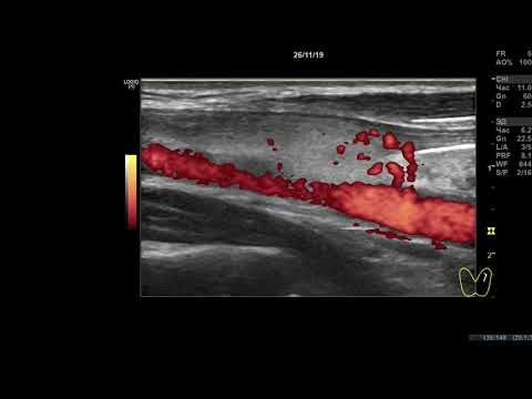 Видео: Клинический случай 18. (УЗИ Щитовидной Железы ) доктор А.В. Ушаков