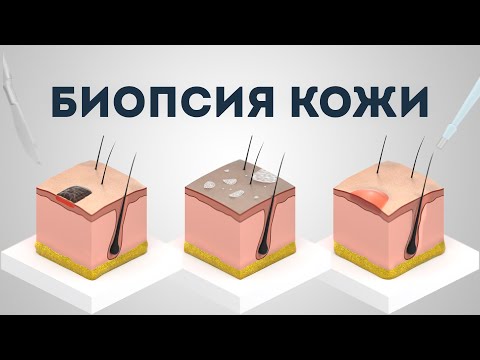 Видео: Биопсия кожи