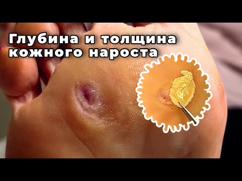Видео: Вынуть толстый слой ороговевшей кожи из глубины