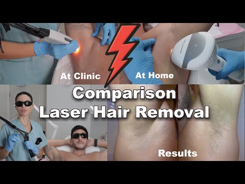 Видео: Я сравнил лазерную эпиляцию дома и в клинике — полная демонстрация сравнения и результаты до и после