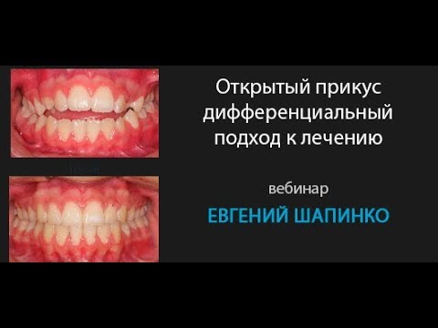 Видео: Открытый прикус - дифференциальный подход к лечению