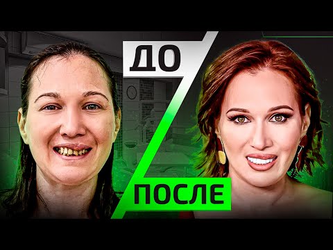 Видео: Вы НЕ представляете как сильно зубы влияют на вашу внешность — До / После