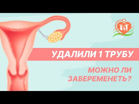 Видео: 🤷 Удалили 1 трубу - можно ли забеременеть?