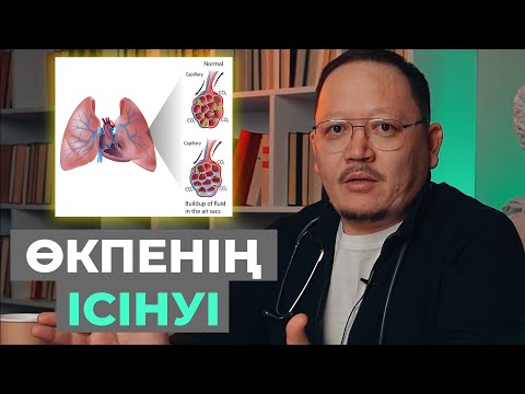 Видео: Өкпенің ісінуі! Өкпеге су жиналу белгілері!  Қалай емделеміз?