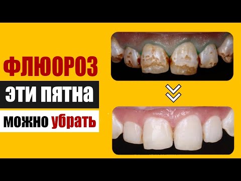 Видео: Пятна на зубах можно убрать или почему флюороз - не приговор!