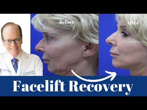 Видео: Восстановление после подтяжки лица: подробное руководство | Доктор Джоэл Копельман