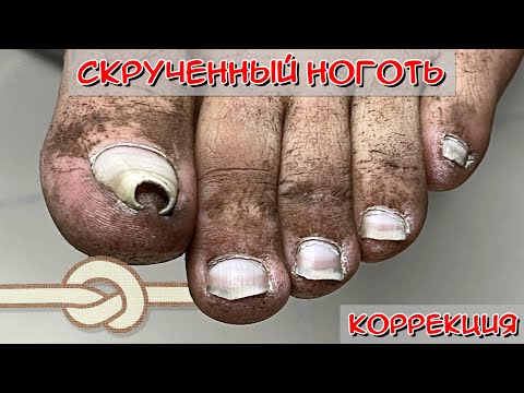 Видео: Скрученные ногти - Капитан Аэро (Часть 1)/ Коррекционная система титановая нить