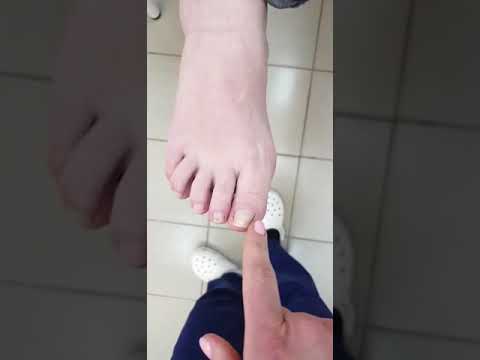 Видео: Титановая нить, установка