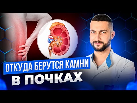 Видео: Откуда берутся камни в почках | Причины мочекаменной болезни