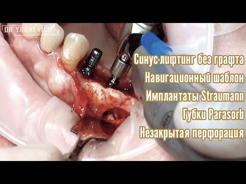 Видео: Синус-лифтинг без графта без закрытия перфорации, губки Parasorb, шаблон, имплантация Straumann