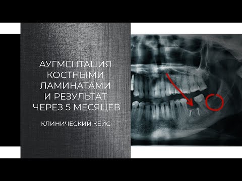 Видео: Аугментация костными ламинатами и результат через 5 месяцев