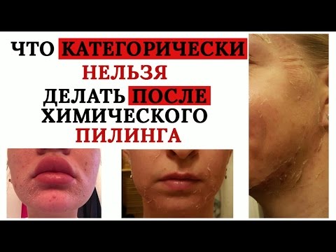 Видео: Типичные ошибки после химического пилинга! Что нельзя делать!