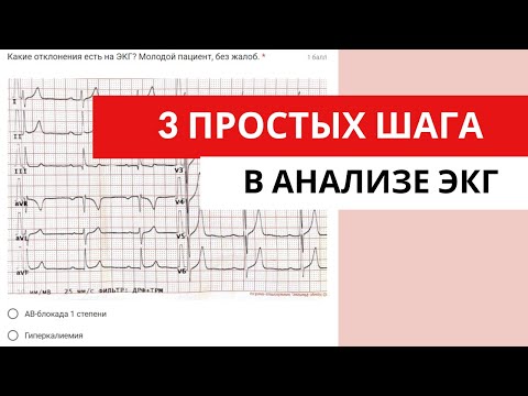 Видео: 3 простых шага в анализе ЭКГ. Понятный алгоритм анализа ЭКГ.