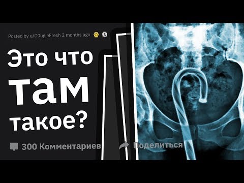 Видео: Врачи Рассказывают о ХУДШИХ Травмах из-за Ceк$@ #2