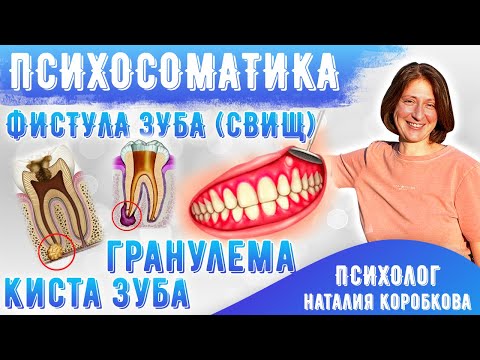Видео: Киста зуба /  Гранулема / Фистула (свищ)  Психосоматика