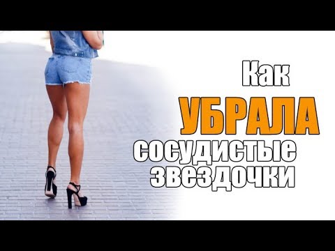 Видео: СКЛЕРОТЕРАПИЯ и ЛЕЧЕНИЕ ВАРИКОЗА: Ответы Доктора / Мой Опыт