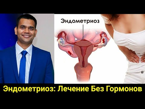 Видео: Эндометриоз: Лечение Без Гормонов | симптомы причины лечение | Доктор Вивек
