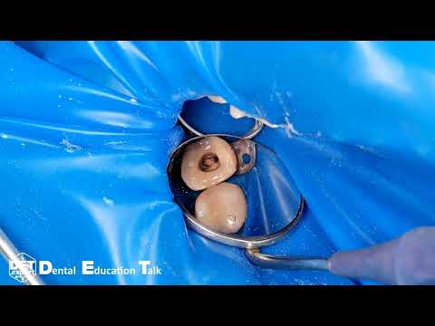 Видео: Глубокое поддесневое разрушение 17 и преэндодонтический билдап DET.expert & Vladmiva & MyDent24 (4K)
