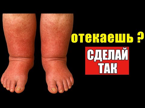 Видео: ОТЕКИ ИСЧЕЗНУТ! Простой метод с содой, который работает!