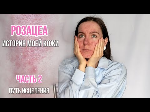 Видео: РОЗАЦЕА. ИСТОРИЯ МОЕЙ КОЖИ. ЧАСТЬ 2: ПУТЬ ИСЦЕЛЕНИЯ