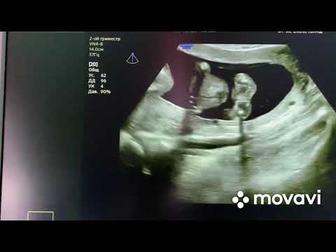 Видео: УЗИ 16 недель пол мальчик