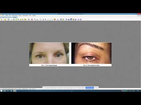 Видео: Неудачные последствия ботокса - описание