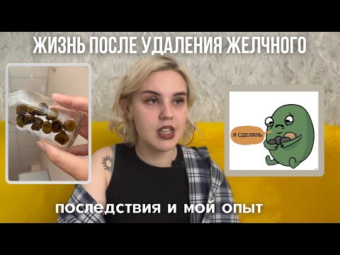 Видео: ЖИЗНЬ ПОСЛЕ УДАЛЕНИЯ ЖЕЛЧНОГО ПУЗЫРЯ/ последствия, мой опыт
