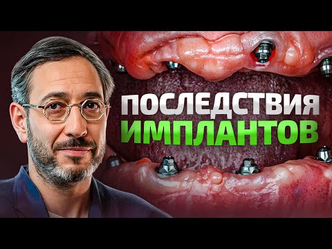 Видео: Имплантация зубов в 2025 – жалобы. Что НЕ так с имплантами?