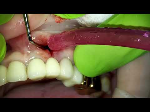 Видео: Удаление кисты верхней челюсти