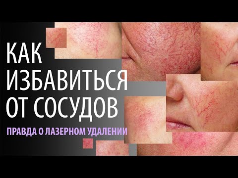 Видео: Как избавиться от сосудов на лице?