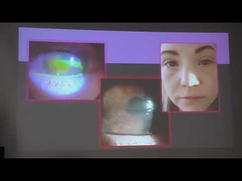 Видео: Сухой глаз (2) Чернакова Г.М. Сухой глаз и вирусы