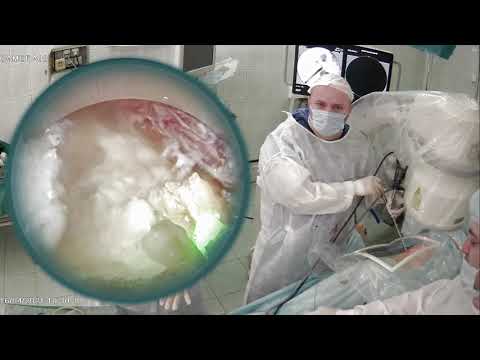 Видео: Удаление коралловидного камня в почке.