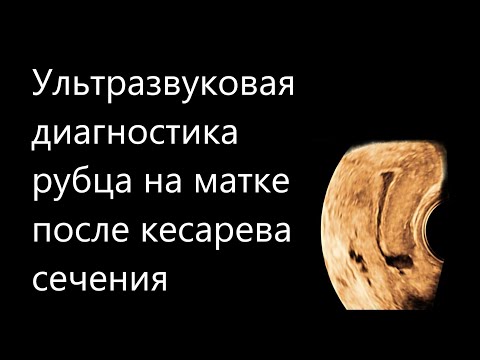 Видео: Ультразвуковая диагностика рубца на матке после кесарева сечения