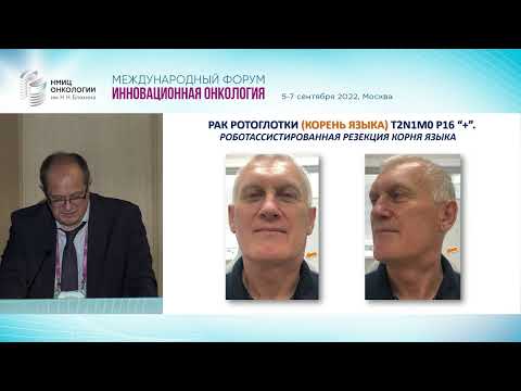 Видео: Рак ротоглотки.  Вчера и сегодня. Кропотов М.А.