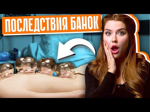 Видео: МИФ, В КОТОРЫЙ МЫ ВЕРИМ | Вред и польза медицинских банок