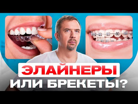 Видео: БРЕКЕТЫ или ЭЛАЙНЕРЫ. Что выбрать? Что дешевле?