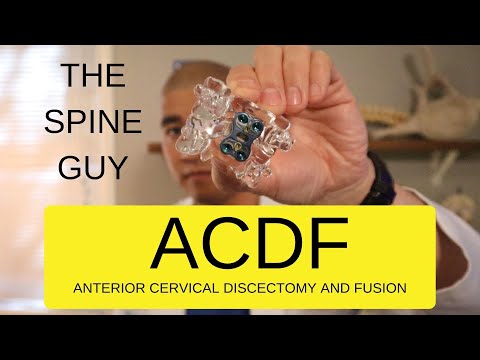 Видео: Стеноз шейного отдела позвоночника с радикулопатией - Часть 5 - ACDF